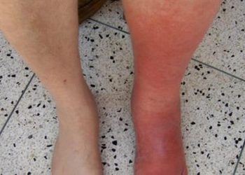 Reducing Cellulitis with Compression Therapy