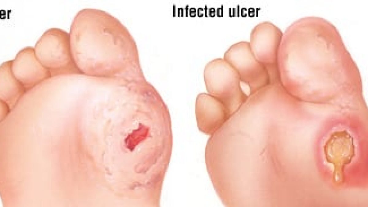 ulcer on heel of foot