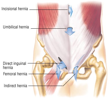 Umbilical Hernia - MILE HIGH HERNIA INSTITUTE Rocky Mountain