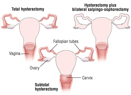 Why Some Women Bleed Years After A Hysterectomy