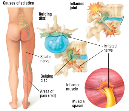 Sciatica, Causes, Signs and Symptoms, Diagnosis and Treatment 