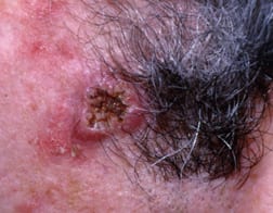 Patient Basics: Squamous Cell Carcinoma of the Skin | 2 Minute Medicine