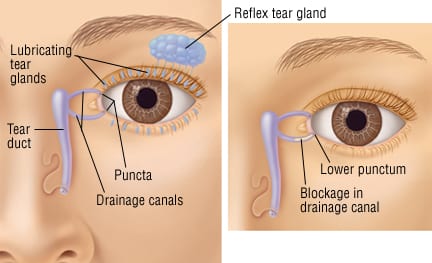 lacrimal punctum swollen