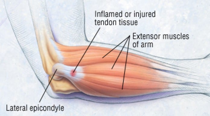 Patient Basics: Tendonitis | 2 Minute Medicine