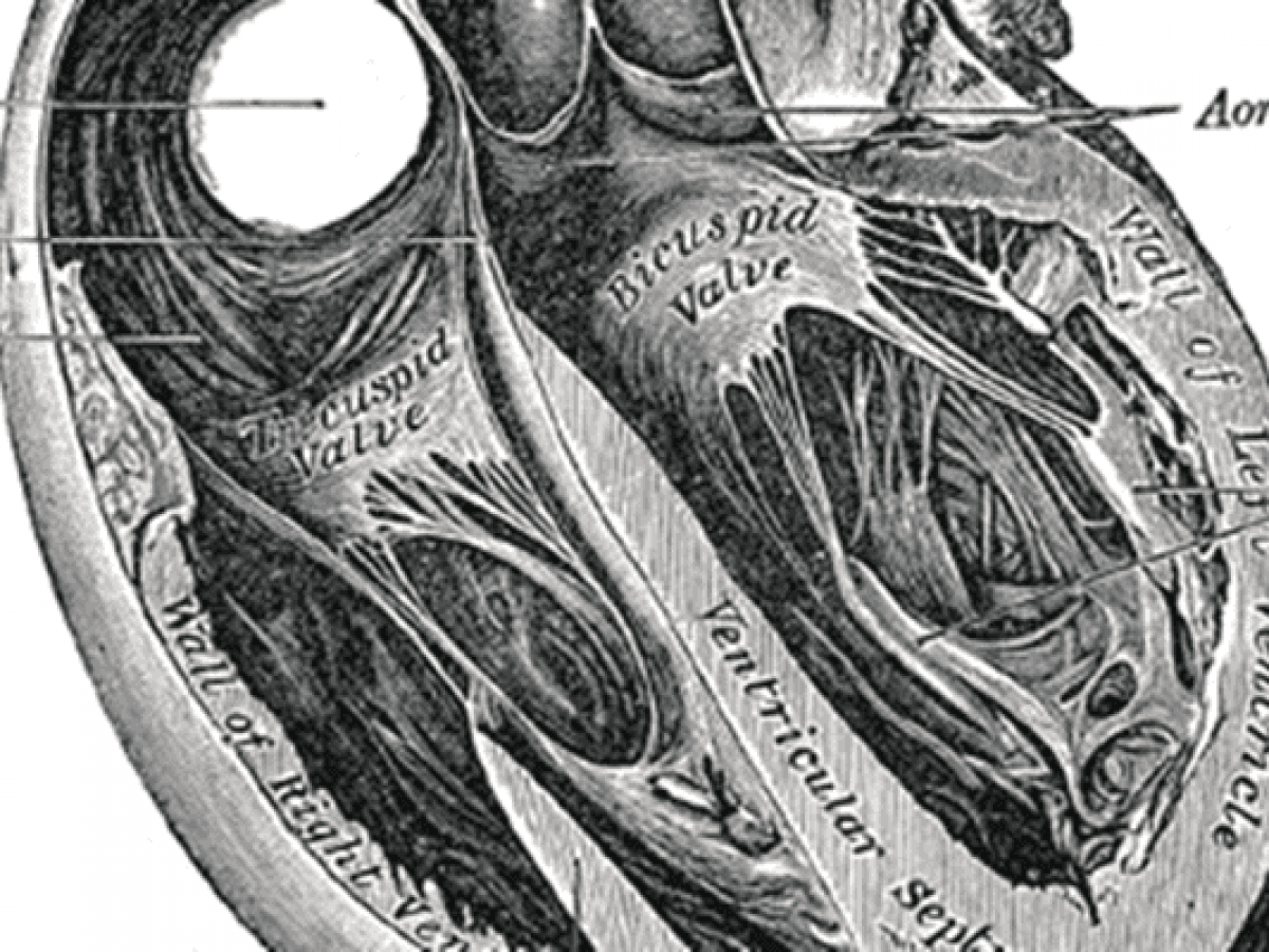 Pericardial Drain Management Protocol - Best Drain Photos Primagem.Org