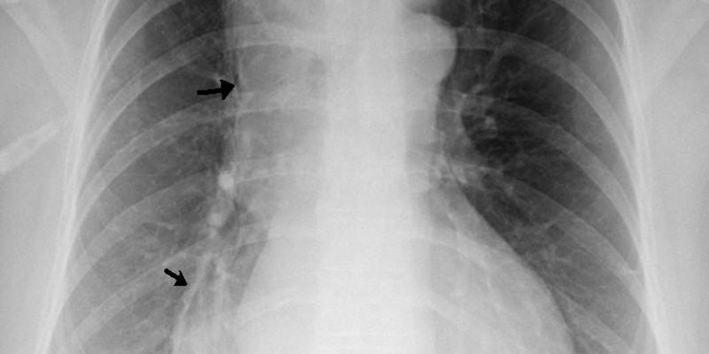 Peroral endoscopic myotomy in patients with idiopathic achalasia | 2 ...